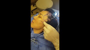 Temporal Brow Lift (GRAPHIC)