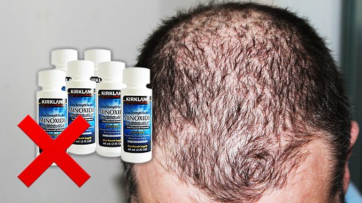 Minoxidil DOES NOT Prevent Hair Loss - Read This Before Using It!
