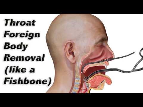 How a Fishbone (or Other Foreign Body) is Removed from the Throat Without Sedation