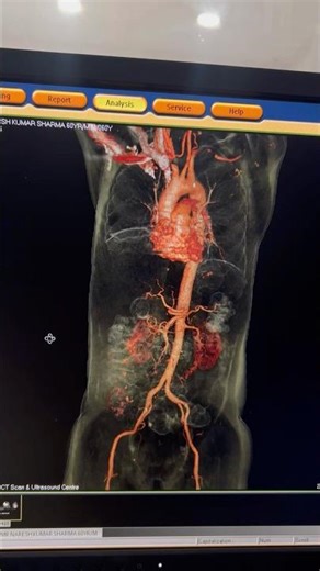 CT Angiography of Chest & Abdominal Arteries #shorts