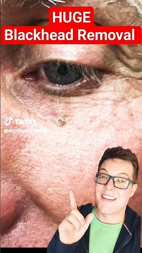 Enormous BLACKHEAD REMOVAL Under The Eye #shorts