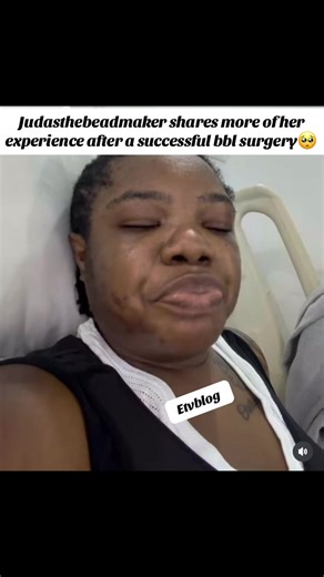 Judasthebeadmaker's Journey After BBL Surgery