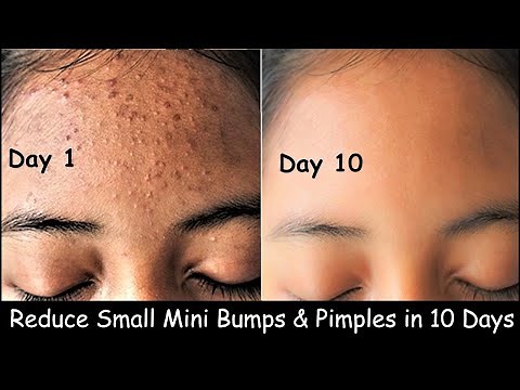 Get rid of Tiny Bumps on Face - Small head bumps & Pimples | Clear Skin in 10 days