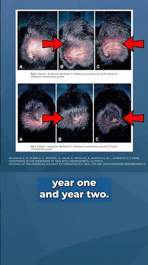 Why Finasteride Needs MORE Time to Work ⏰