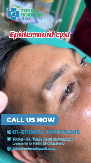 Understanding Epidermoid Cysts: Causes and Symptoms