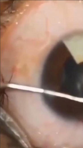 “Artificial Iris Implant Surgery Explained in 30 Seconds | Life-Changing Eye Restoration!”