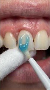 🦷 Watch How a Dentist Stabilizes a Loose Tooth Using Modern Dental Splinting Techniques to Support