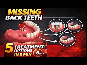 5 Best Ways to Replace Missing Back Teeth | Dr.Dentique-hub