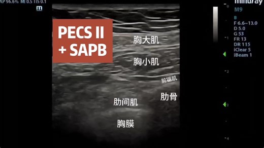 胸肌平面PECS II阻滞 SAPB前锯肌阻滞