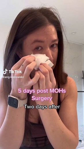 MOHs Surgery Update - bandage removal vs 5 days after. Stitches come out today! I had a basil cell that had to be removed. #mohs #mohssurgery #surgery #skincancer #stitches #healthcare #skincare #skincareroutine #skincancerawareness #skincancercheck #checkyourmoles #moles #cancer #fyi #awareness #scar #healthcare #incaseyoudidntknow #incaseyouwerewondering #fyp #information #educational #skincancerjourney #skincancerprevention