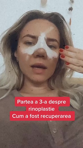 Recuperare dupa operatie de rinoplastie - Ziua 4