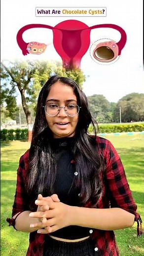 chocolate cyst #chocolatecyst #disease #medico #medicalstudy #forwoman #shortvideo