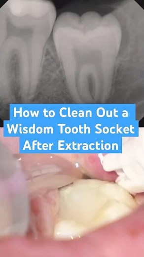 How to Clean Out a Wisdom Tooth Socket After Extraction #dentist #wisdomtoothextraction #howto