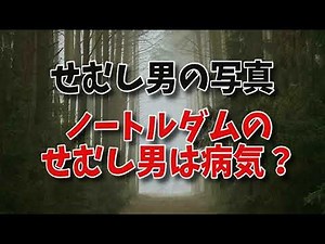 せむし男の写真…ノートルダムのせむし男は病気？せむし病気画像やせむし病の意味（くる病）などせむしについて