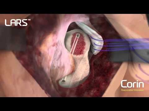 LARS™ Gluteal Repair - Surgical Techhnique