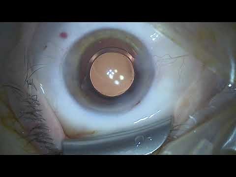 Clear Lens Extraction - refraktiver Linsenaustausch