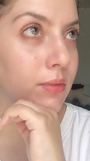 Melasma is a common skin condition characterized by brown or gray patches on the face, typically on the cheeks, forehead, chin, and upper lip. While there is no definitive cure for melasma, several treatment options can help manage and reduce its appearance. It’s important to note that results may vary, and in today’s video I am giving you a personalized treatment plan to remove melasma at home. This for people struggling with stubborn melasma. Remember that consistency and patience are key when