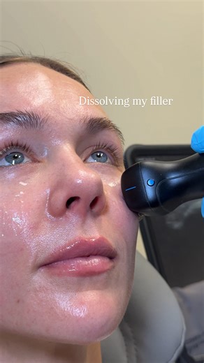 Celeste Thomas, RN, BSN | Acne expert | Best way to dissolve filler w/o surgery is to identify it with ultrasound before you inject the enzyme that breaks it down. If you’re... | Instagram