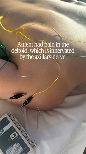 Kendrick Pifer, MSTOM, L.Ac. on Instagram: "One of my favorite ways to treat pain, with a neurofunctional approach. 🪡⚡️"