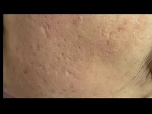 DERMAPEN How To Use it ???? For beginners