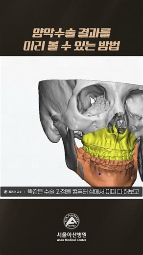 양악수술 결과를 미리 볼 수 있는 방법