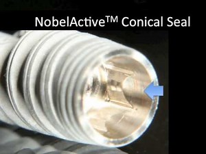 Dental Implant - Dr. Scott MacLean - NobelActive Prosthetics