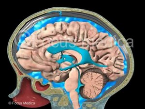 CSF leakage - Neuroanatomy