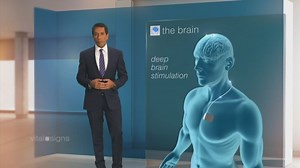 What is deep brain stimulation?