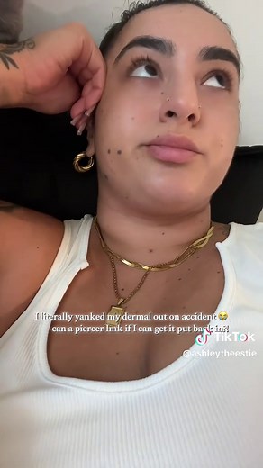 Getting My Dermal Piercing Redone - Seek Advice