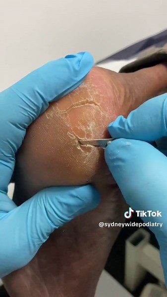 Deep Heel Fissures Treatment - Podiatrist Satisfying Video