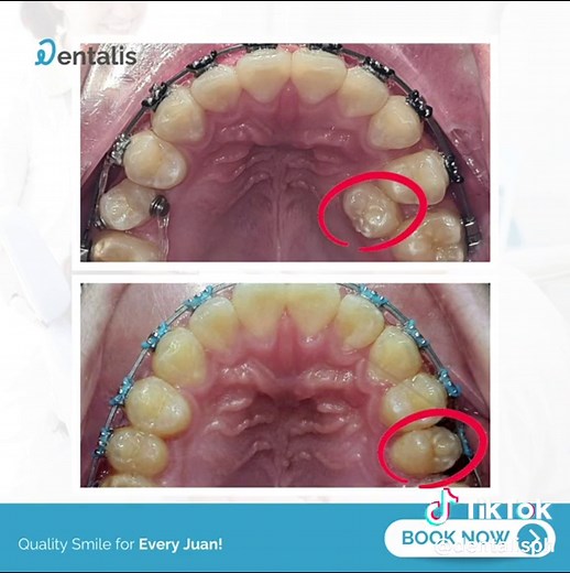 Precision Tooth Movement with TADs: Before & After Transformation