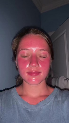 Understanding Sun Poisoning Symptoms and Treatment