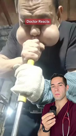 Glassblowers disease. #doctor #glassblowing #cheeks #cheaky #buccinator #medical