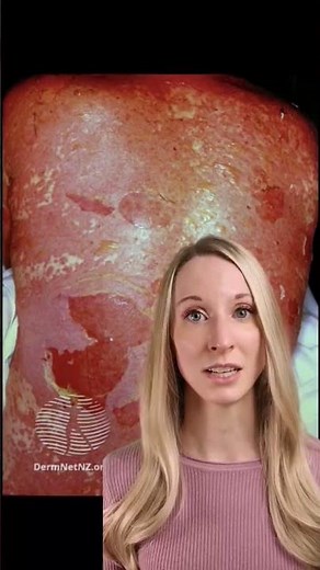 Steven Johnson syndrome