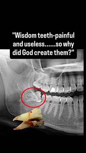 Why do we have wisdom teeth? Wisdom teeth (third molars) are leftovers from human evolution. Thousands of years ago, our ancestors had: Large jaws Hard, coarse diets (raw meat, roots, nuts, leaves) This caused more tooth wear & tear, so an extra set of molars helped them chew properly in adulthood. That’s why wisdom teeth typically erupt between 17–25 years, when the earlier molars were worn down. Are they really required today? No — not for most people. Today we have: Softer, cooked foods Small