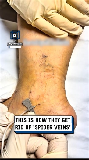 They are injected with a foam 💉 | UNILAD Tech