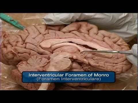 Mammillary Body, Fornix, Foramen of Monro, Pineal Gland, Tectum. From "Dissection of the Brain" DVD