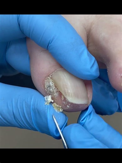 A large piece of inlaid armor was unearthed on one side! Dead skin removed. #foot