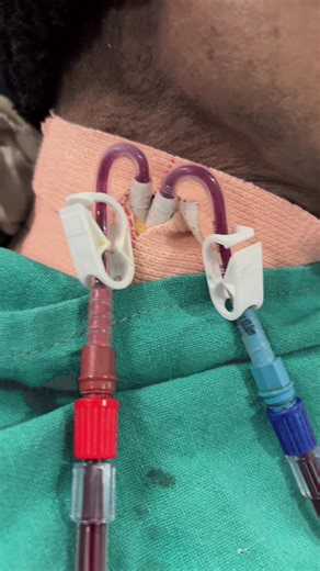 Jugular catheter hemodialysis chronic kidney disease and stage 5 with HTN and #dialysis #medical #worldhealthorganization #healthcare #dialysislife🙏❤️
