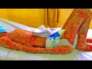 Crusty Flake Skin! Lesions, Peel & Psoriasis