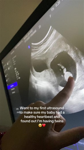 Discovering Twins at My First Ultrasound