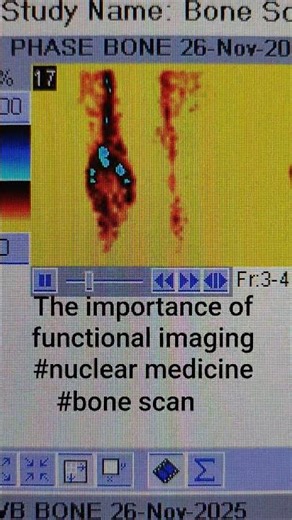 this 3 phase bone scan