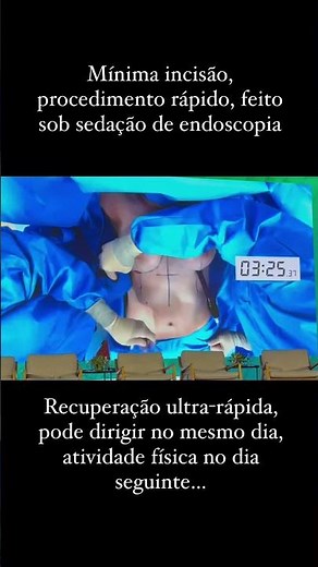 Nova Técnica de Prótese Mamária: Preservé com Recuperação Ultra Rápida #semexageros
