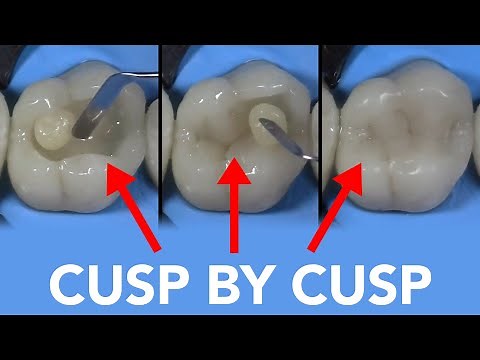 Class II Restoration with G-aenial A'CHORD