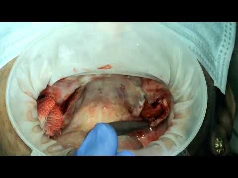 Part2 - Anatomically guided Pterygoid implant placement with Noris Pteryfit implant - DR.C.MURUGAVEL