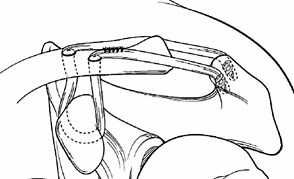 AC Separation | Shoulder Injuries | Dr. Christopher Ahmad