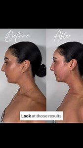 👉 Merrick's newest facial breakthrough Looking to tighten the jawline, chin or neck area? Experience next-gen T-Shape 2, the non-surgical way to reduce the look of a double chin and tighten lax skin along the jawline and neck. January 2026 appointments are now open. The next 10 ladies to book today receive their first T-Shape 2 session for $179 (usually $329))💥 📣 See results in your first session. Don't miss out, click 'GET OFFER' and claim your spot! ➡️ | Artemis Distribution