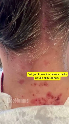 Did you know lice can actually cause skin rashes? 👀 #licetreatment