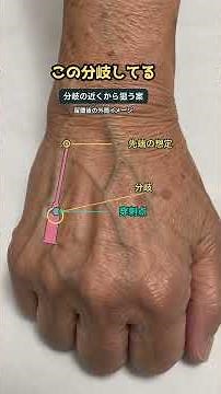 Which Vein to Target on the Back of the Hand? Choosing the Right IV Insertion Site and Catheter T...