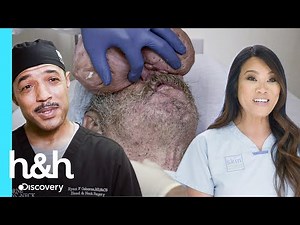 2.1M views · 56K reactions | Gracias a las gestiones de la Dra. Lee, Roger asiste a la Fundación Osborne Head and Neck, lugar donde los mejores especialistas intentarán extraer los enormes bultos de su nariz. | Discovery Home & Health | Facebook